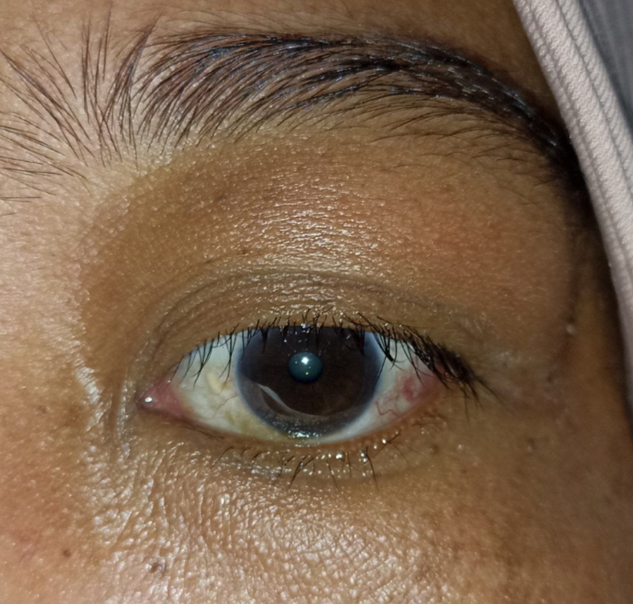 test-cataract-image2.jpg