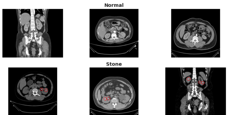 kidney_ctscan.png